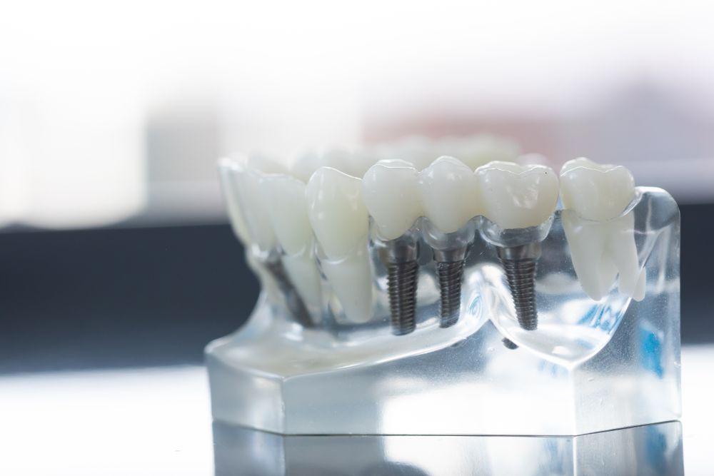 Dental Implants in glass casing